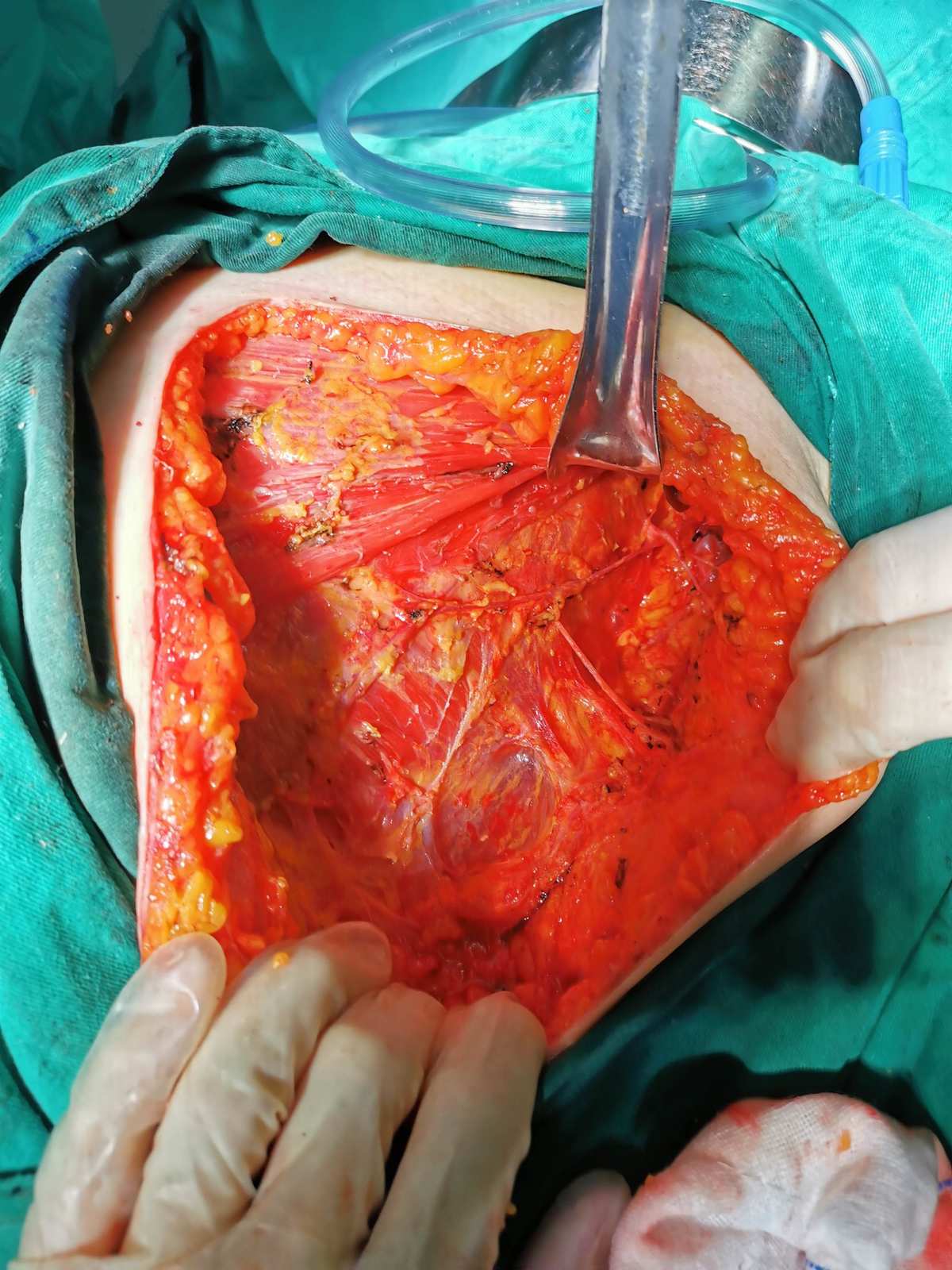 乳腺纤维癌有得治吗_乳腺纤维性癌_