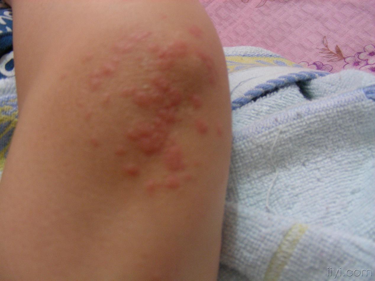 _癌症红斑是什么样子_癌症起红斑还能活多久