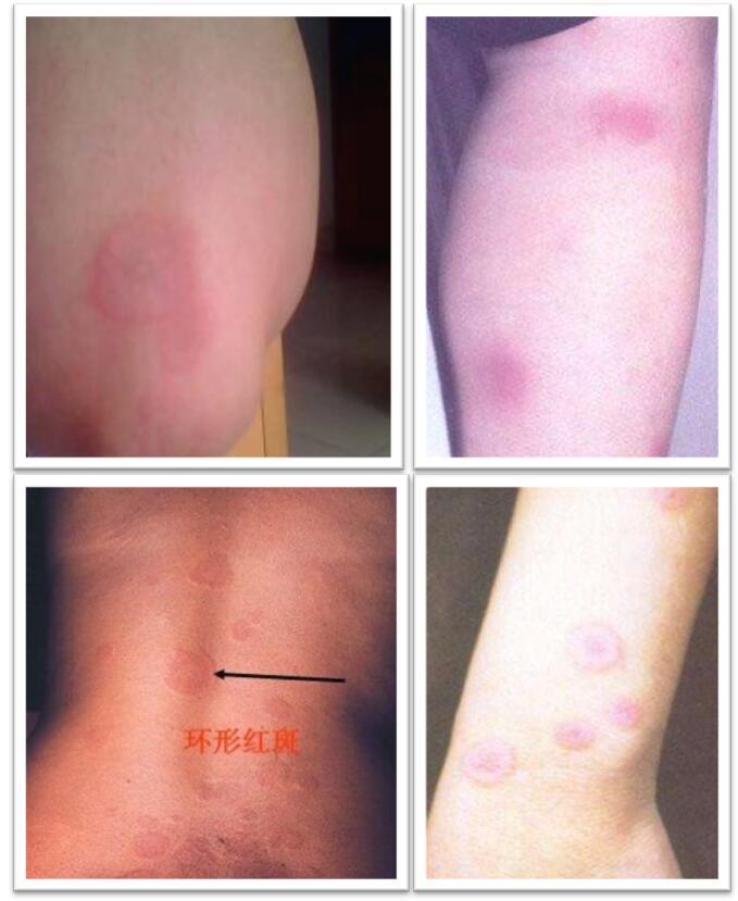 癌症起红斑还能活多久_癌症红斑是什么样子_