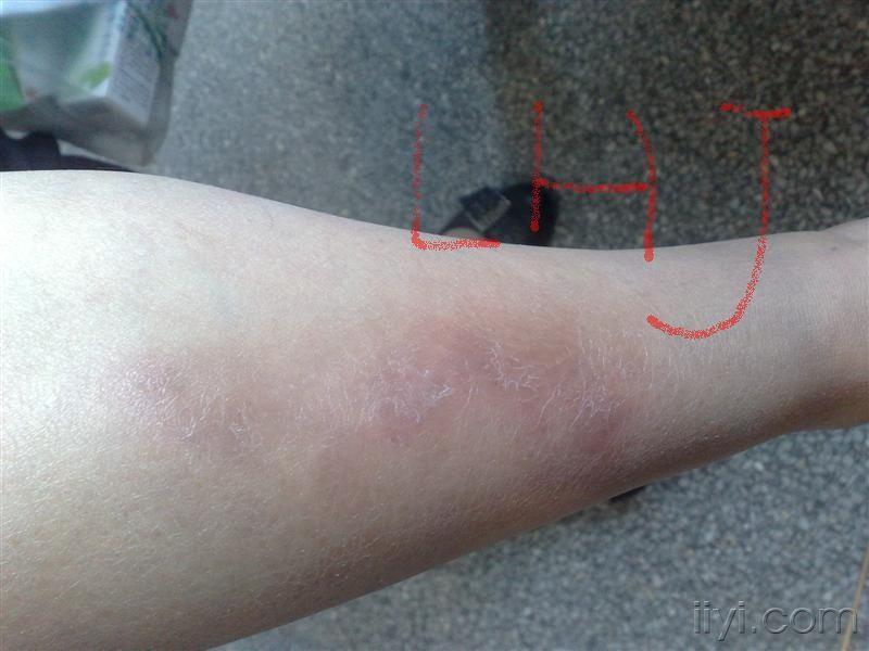 _癌症红斑是什么样子_癌症起红斑还能活多久