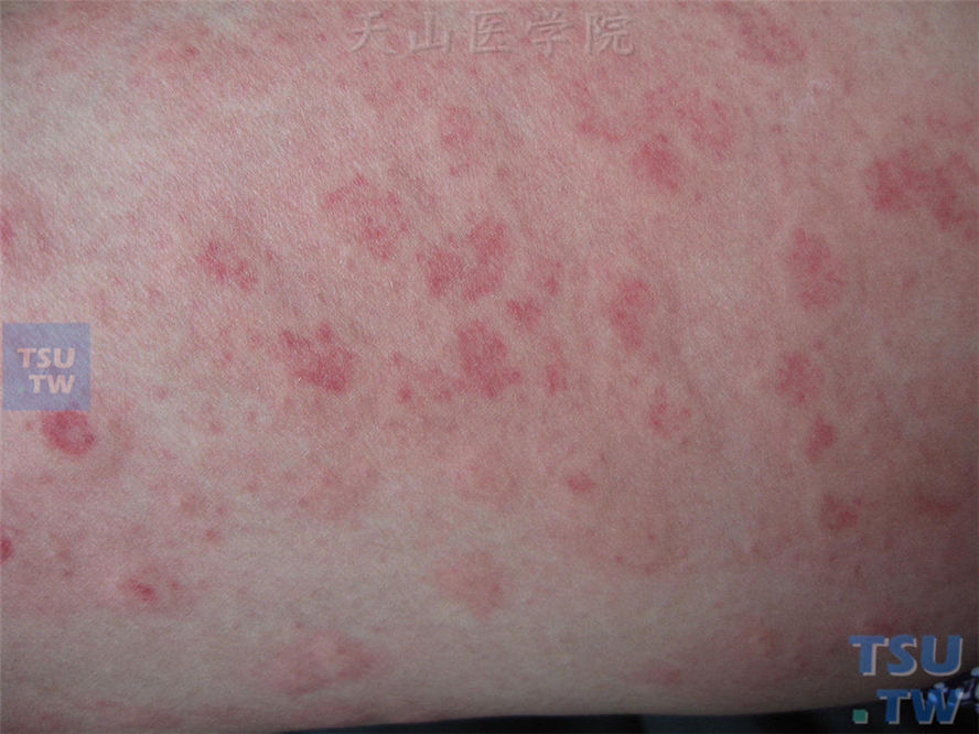 典型预防症状病治红斑种什么药__防治红斑性湿疹