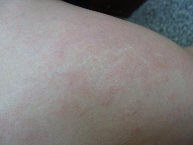 防治红斑性湿疹__典型预防症状病治红斑种什么药