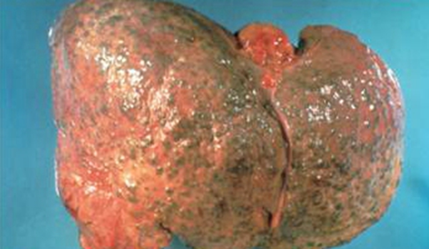 酒精肝硬化继续喝酒能活多久_酒精肝硬化喝酒会怎么样_