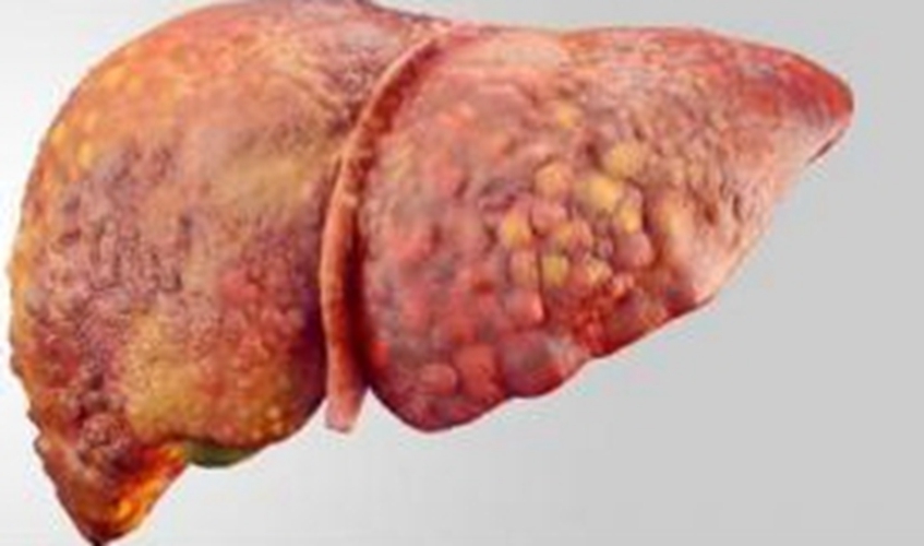 酒精肝硬化喝酒会怎么样_酒精肝硬化继续喝酒能活多久_