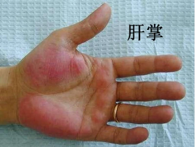 _酒精肝硬化继续喝酒能活多久_酒精肝硬化喝酒会怎么样