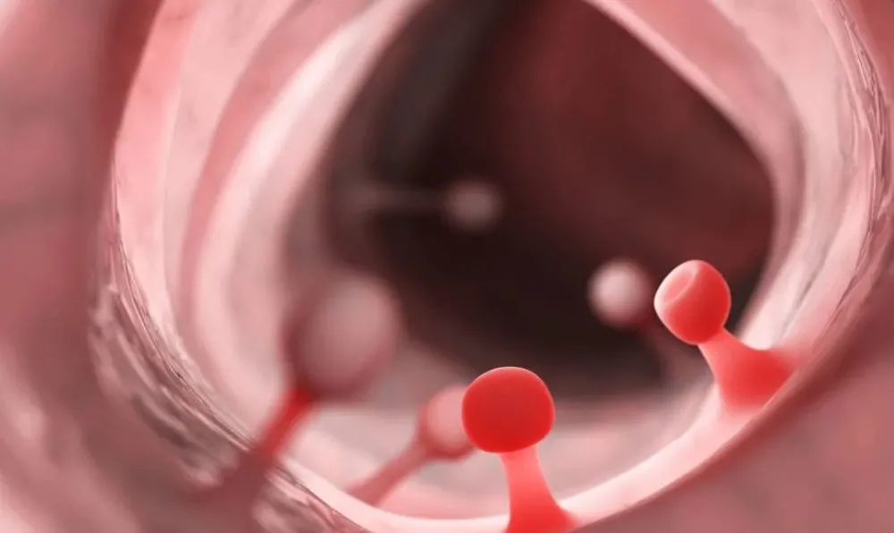 _内膜息肉吃了药之后还出血_内膜息肉吃辣椒会加速长大吗