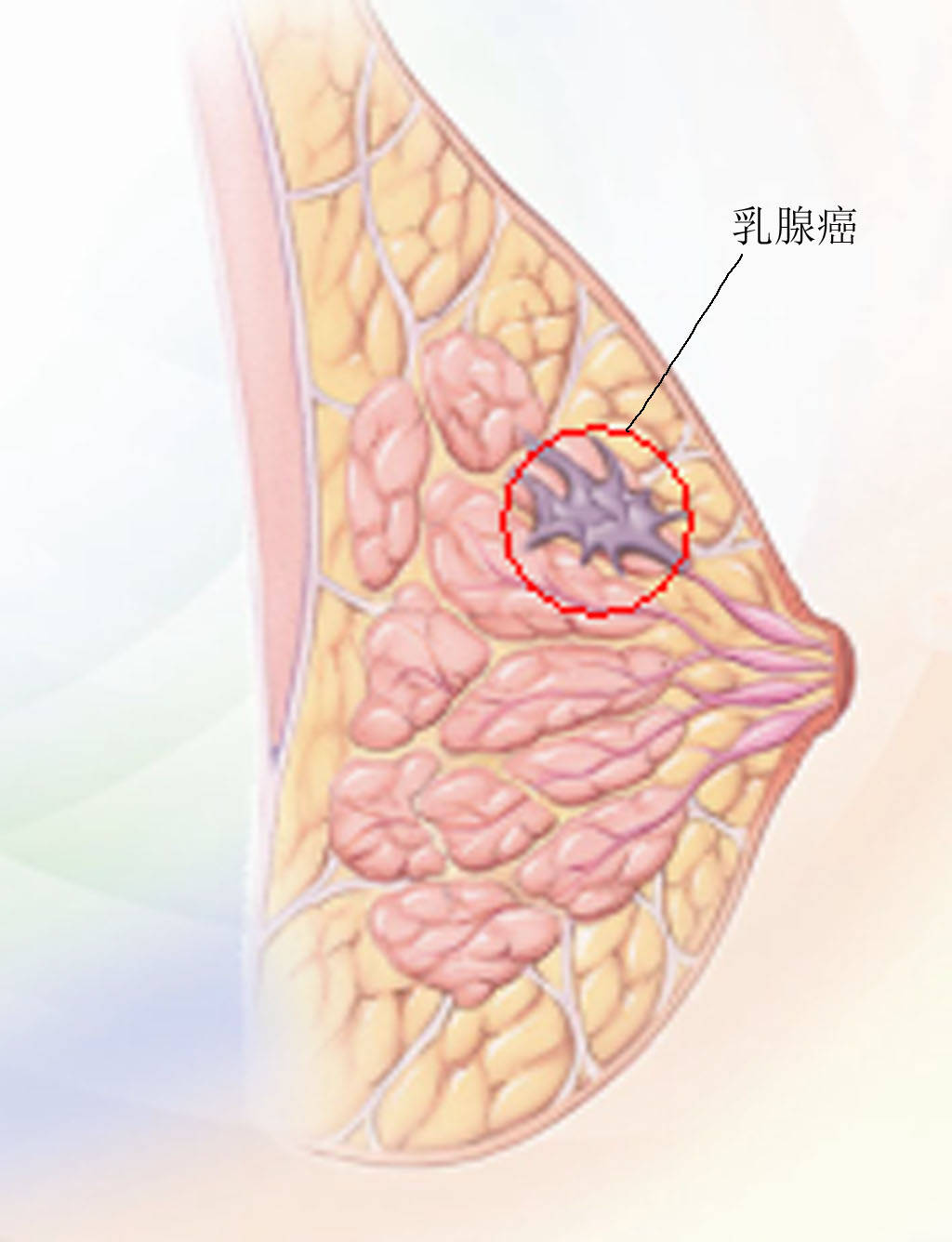 乳腺结节自我检测_乳腺结节自检的方法_