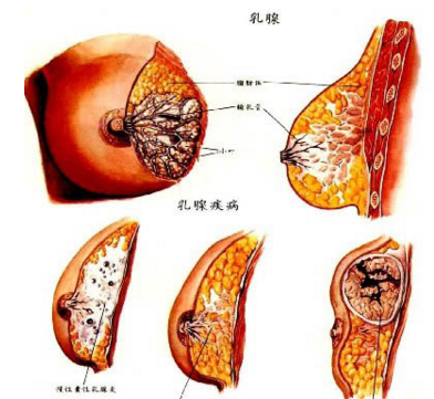 乳腺结节自我检测_乳腺结节自检的方法_
