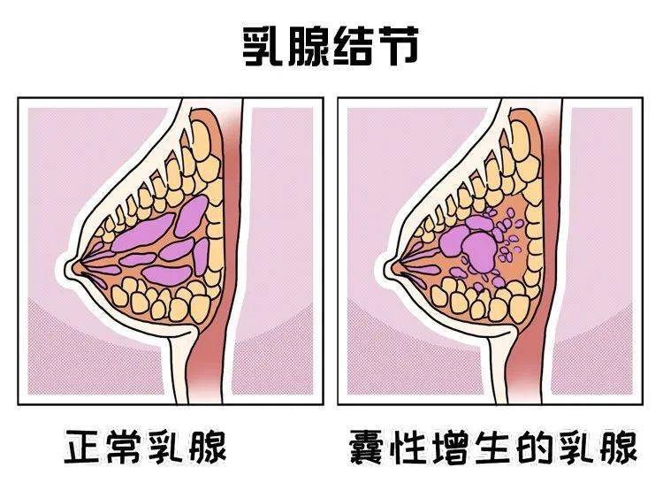 乳腺结节自我检测__乳腺结节自检的方法