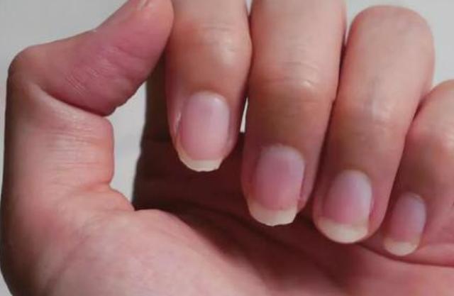 指甲竖纹预示三种疾病__指甲是竖纹是身体的什么信号