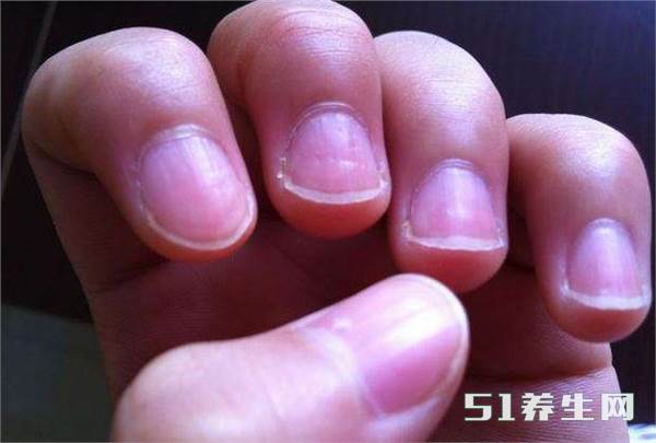 指甲竖纹预示三种疾病_指甲是竖纹是身体的什么信号_