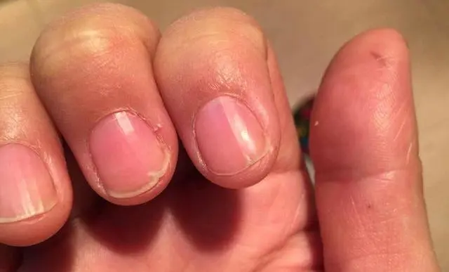 指甲是竖纹是身体的什么信号__指甲竖纹预示三种疾病
