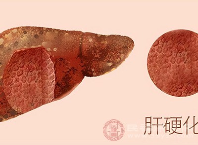 严重的酒精肝还可能导致肝硬化和肝癌等致命性疾病