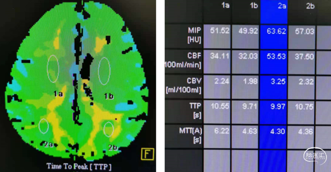 同样脑梗死结局并不相同 降温后牢记1个原则__同样脑梗死结局并不相同 降温后牢记1个原则