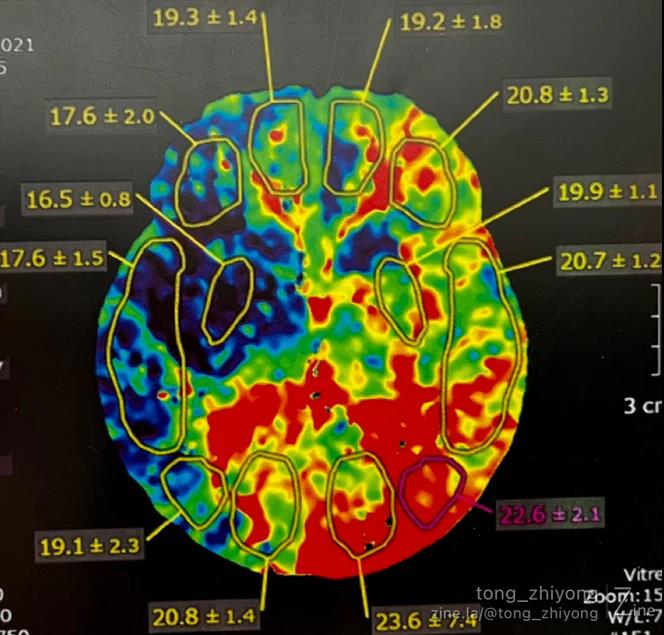 同样脑梗死结局并不相同 降温后牢记1个原则__同样脑梗死结局并不相同 降温后牢记1个原则
