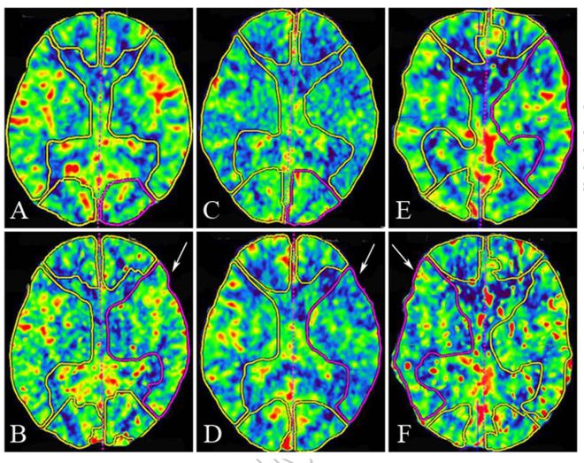 同样脑梗死结局并不相同 降温后牢记1个原则_同样脑梗死结局并不相同 降温后牢记1个原则_