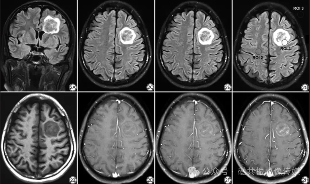 肺癌双腿暗示__腿疼肺癌