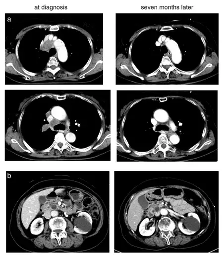 _肺癌双腿暗示_腿疼肺癌
