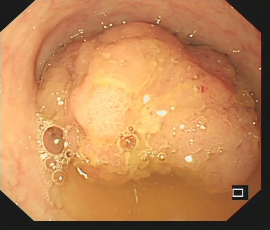 _早期结肠癌怎么发现_结肠早癌是不是癌症