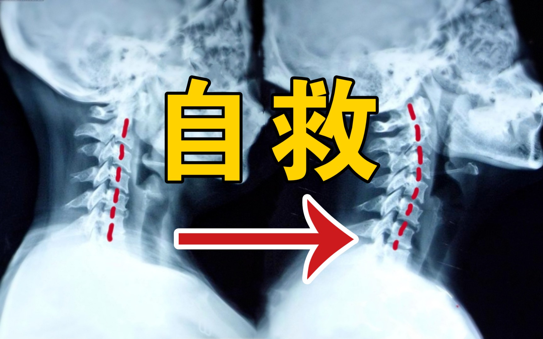 治疗脖颈僵硬酸痛_颈部酸痛僵硬_